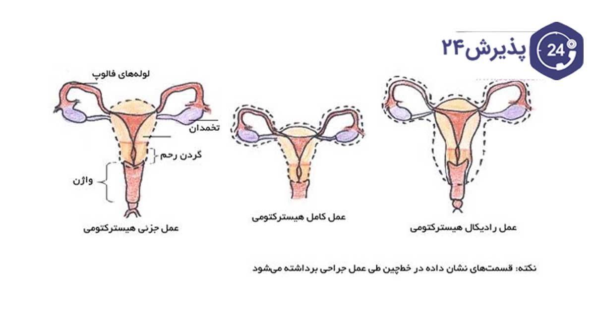 انواع هیسترکتومی 