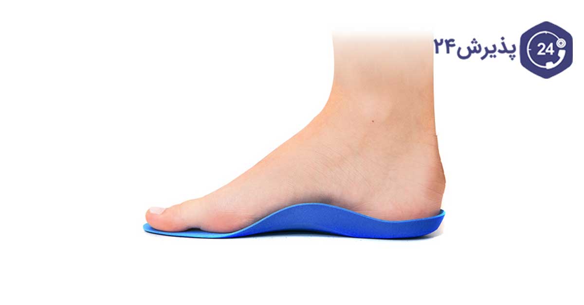 استفاده از آرتوز برای پشتیبانی از قوس کف پا.