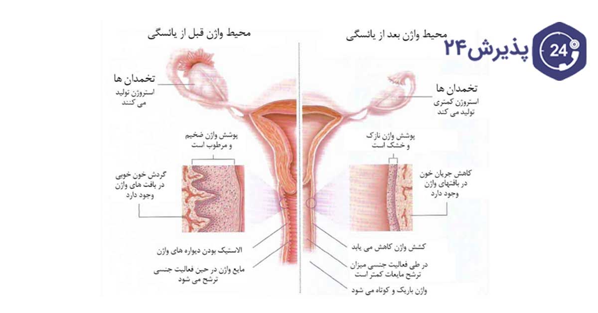 علائم خشکی واژن