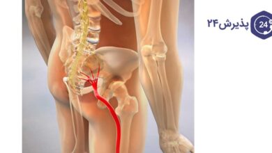 درد ناشی از سیاتیک از کمر شروع و به پاها منتقل می‌شود.