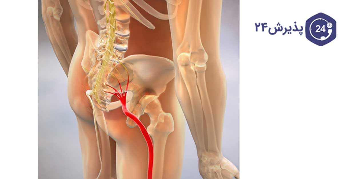 درد ناشی از سیاتیک از کمر شروع و به پاها منتقل می‌شود.