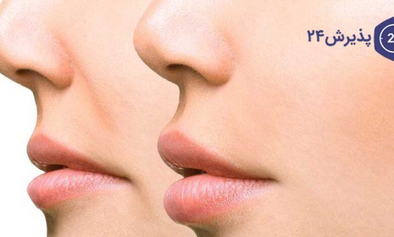 روشهای چاق کردن صورت