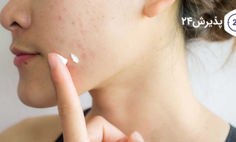 از بین بردن جای جوش
