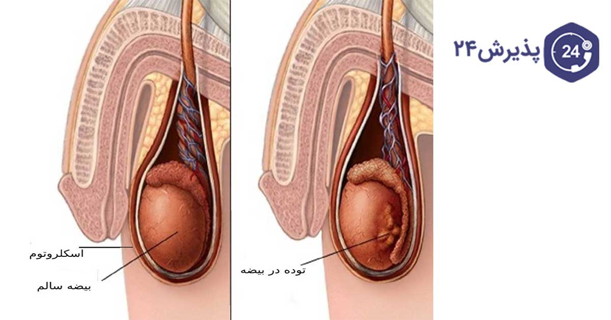 عوامل شل شدن بیضه چیست