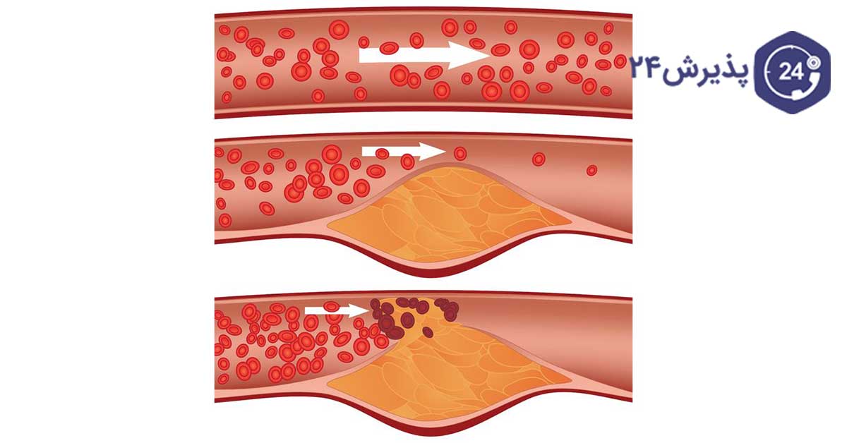 علت چربی خون بالا