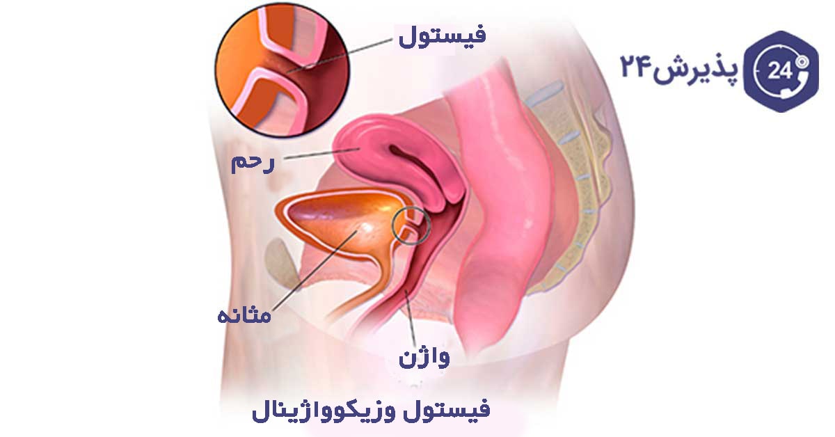 بررسی علل خروج باد از واژن و روش‌های درمان آن