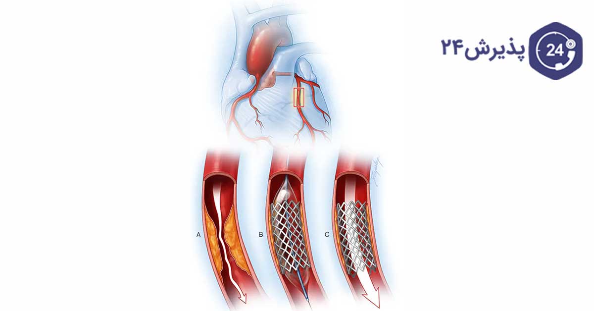 جراحی گرفتگی عروق قلب