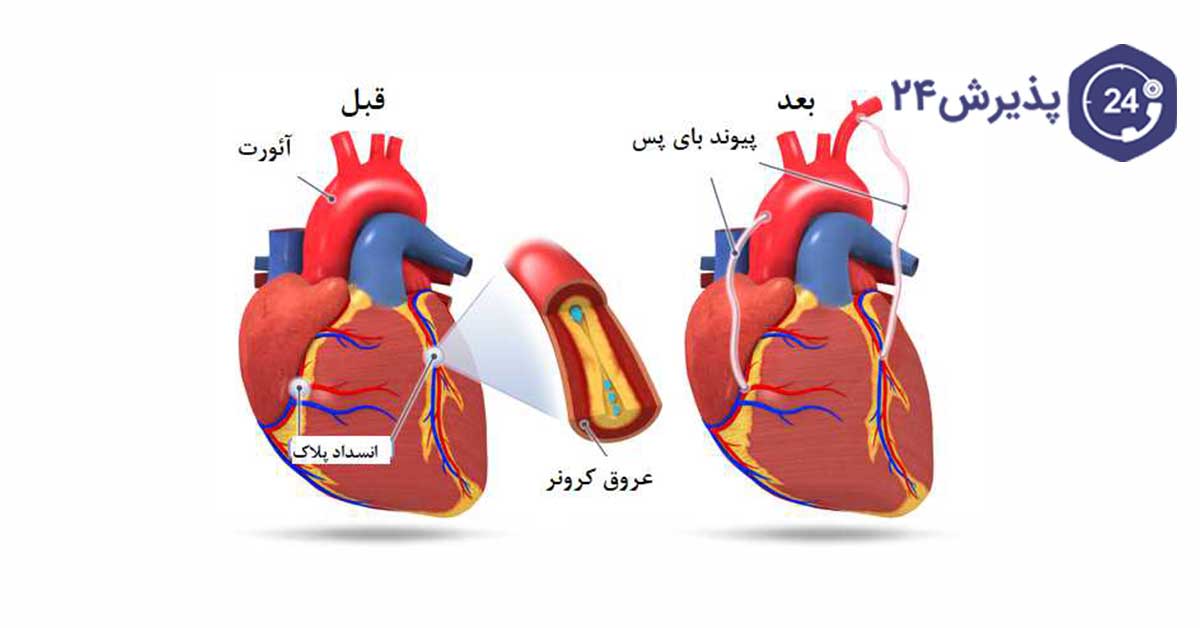 عمل پیوند قلب