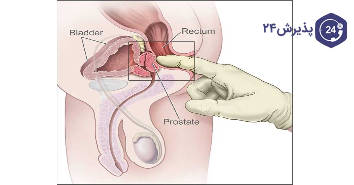 درمان پروستات
