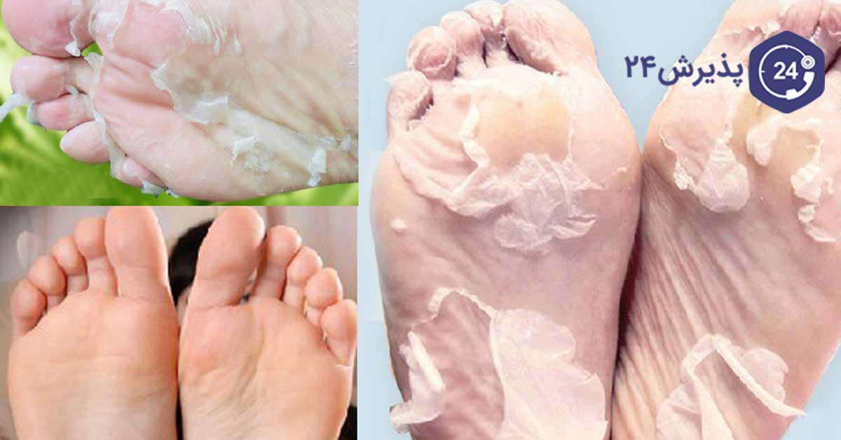 درمان گیاهی پوسته پوسته شدن کف پا