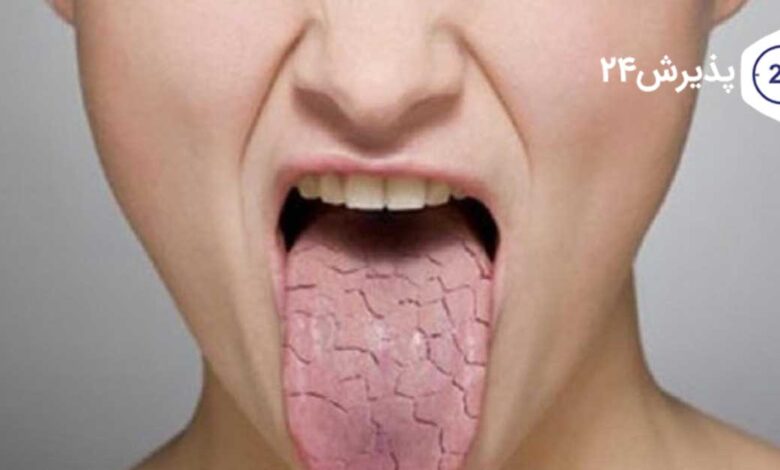 بیماری شوگرن چیست