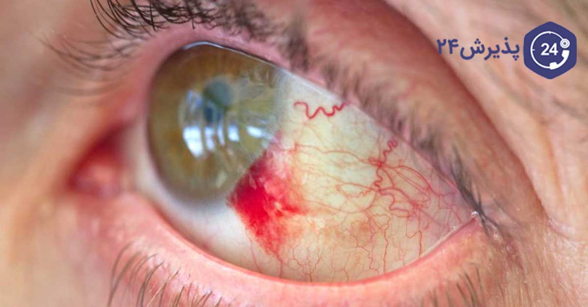 تشخیص علت خونریزی چشم