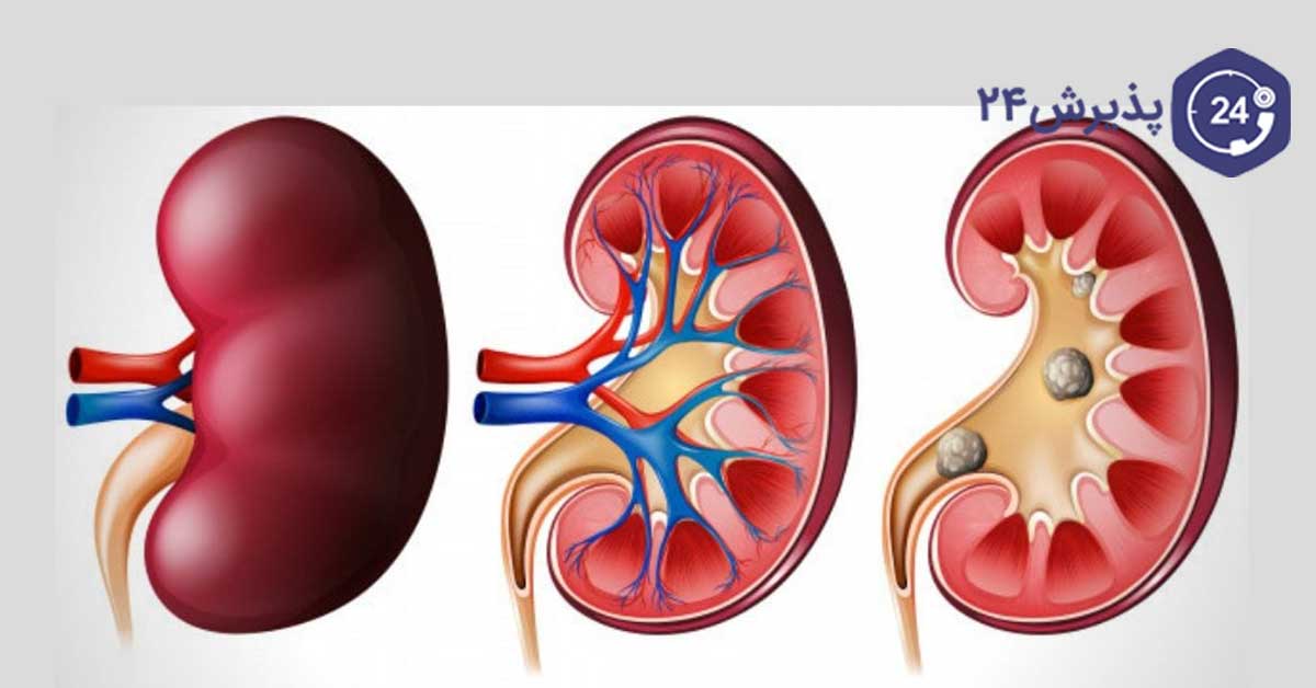 روش های درمانی رسوب کلیه