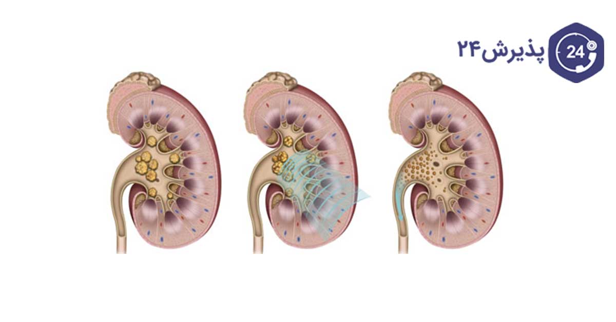 رسوب کلیه در نوزادان