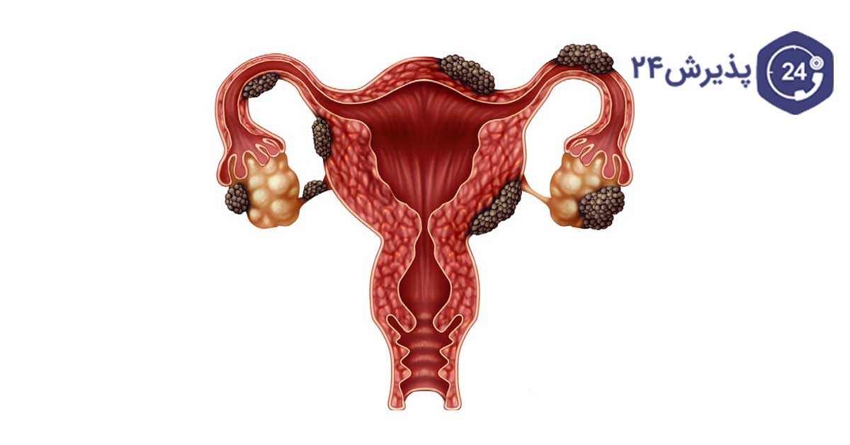 آندومتریوز چیست
