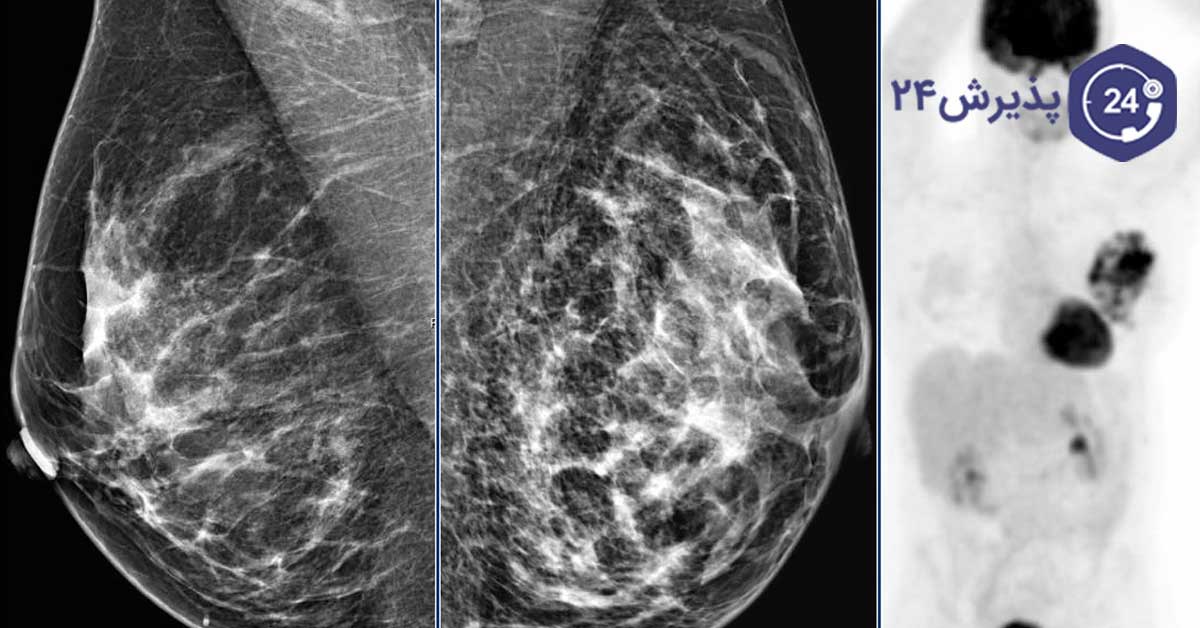 نتیجه ماموگرافی