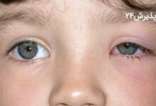 التهاب چشم کودکان چیست