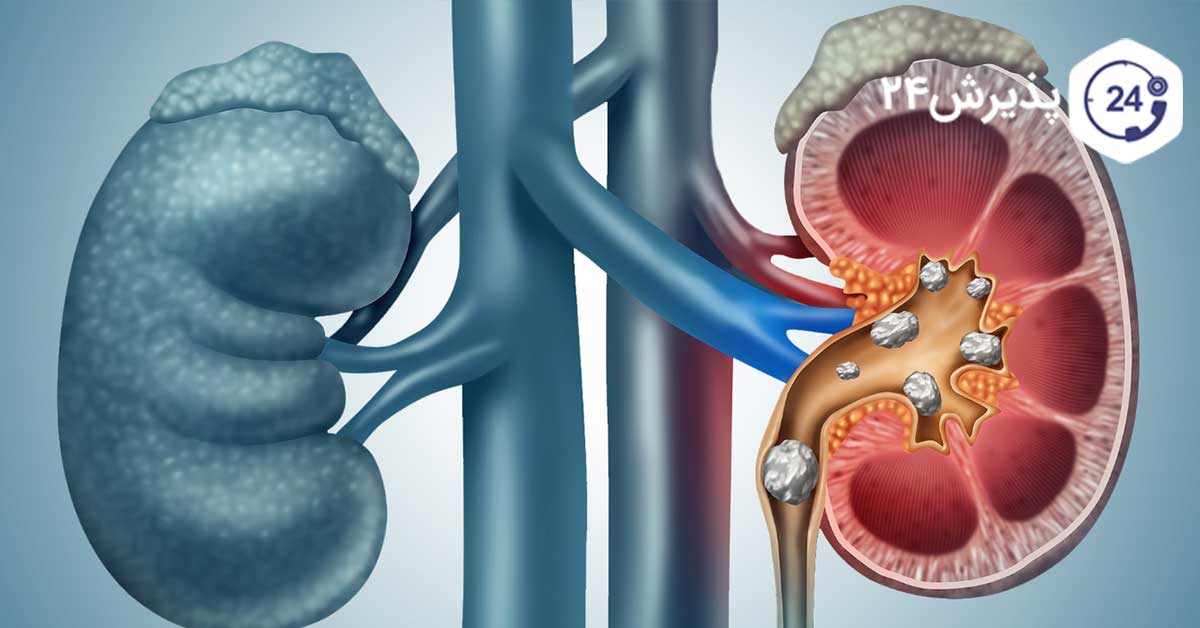 تشخیص سنگ کلیه در دوران بارداری
