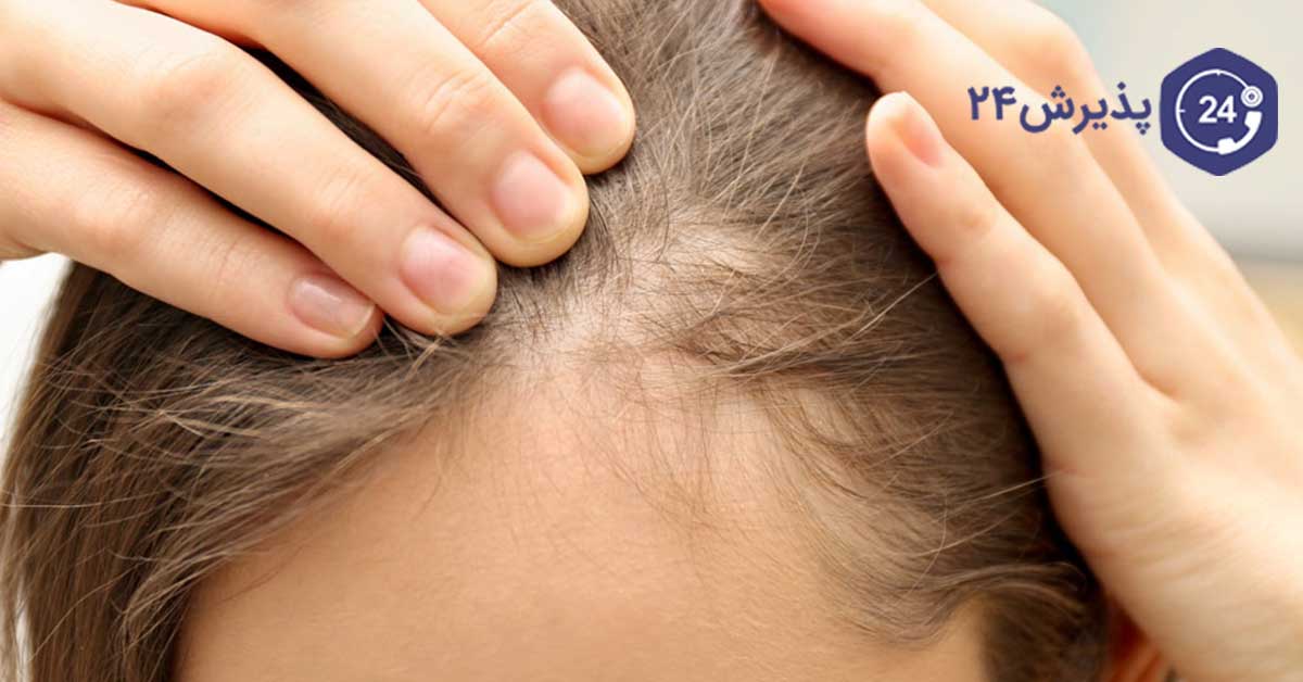علل ریزش مو در دوران شیردهی