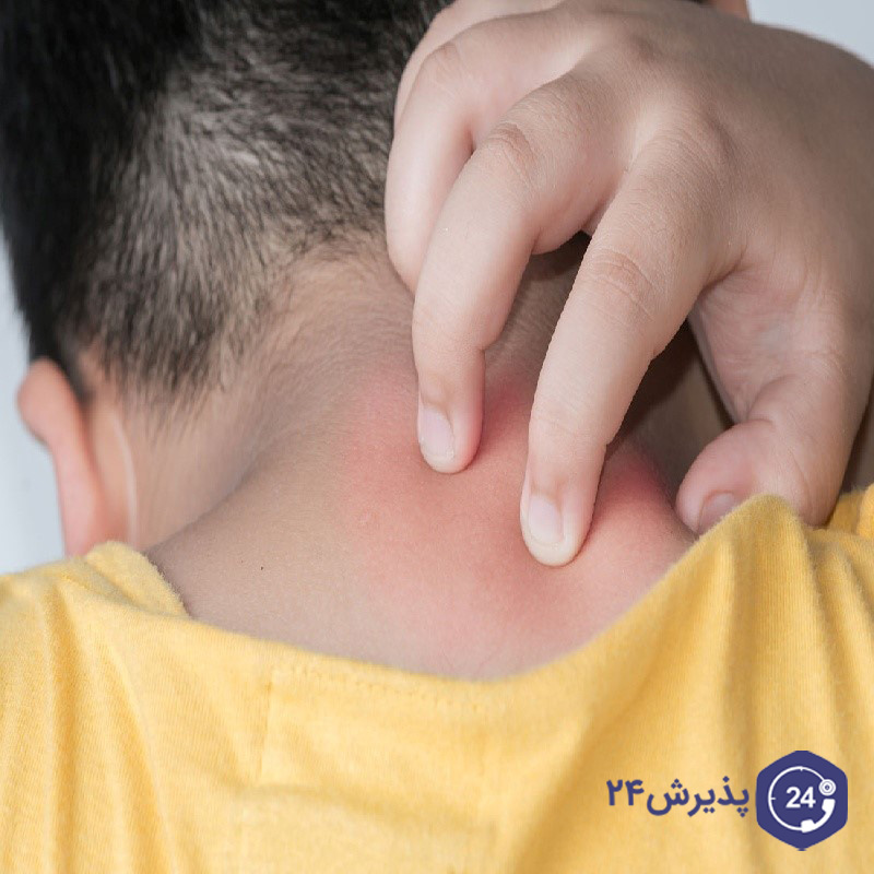 خارش بدن