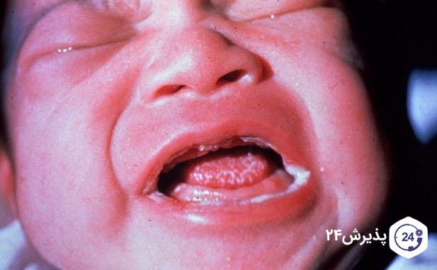 درمان برفک دهان نوزاد