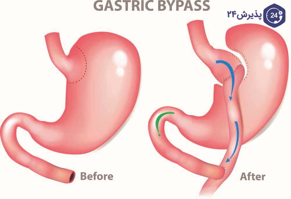 قبل و بعد عمل بای پس معده