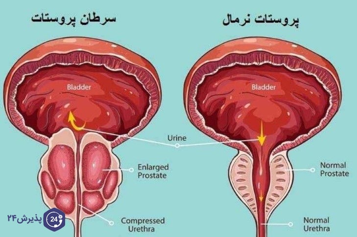 آیا رابطه جنسی زیاد باعث پروستات میشود؟
