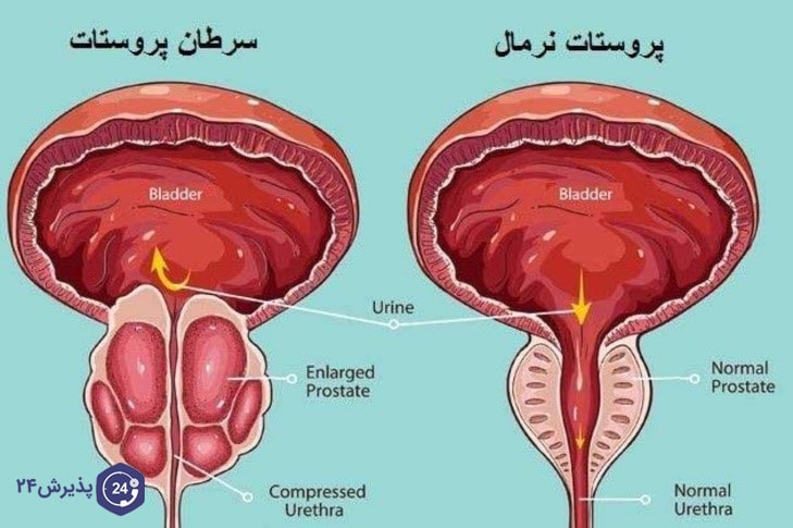 سرطان پروستات چیست؟ 5 روش درمان موثر سرطان پروستات | پذیرش۲۴