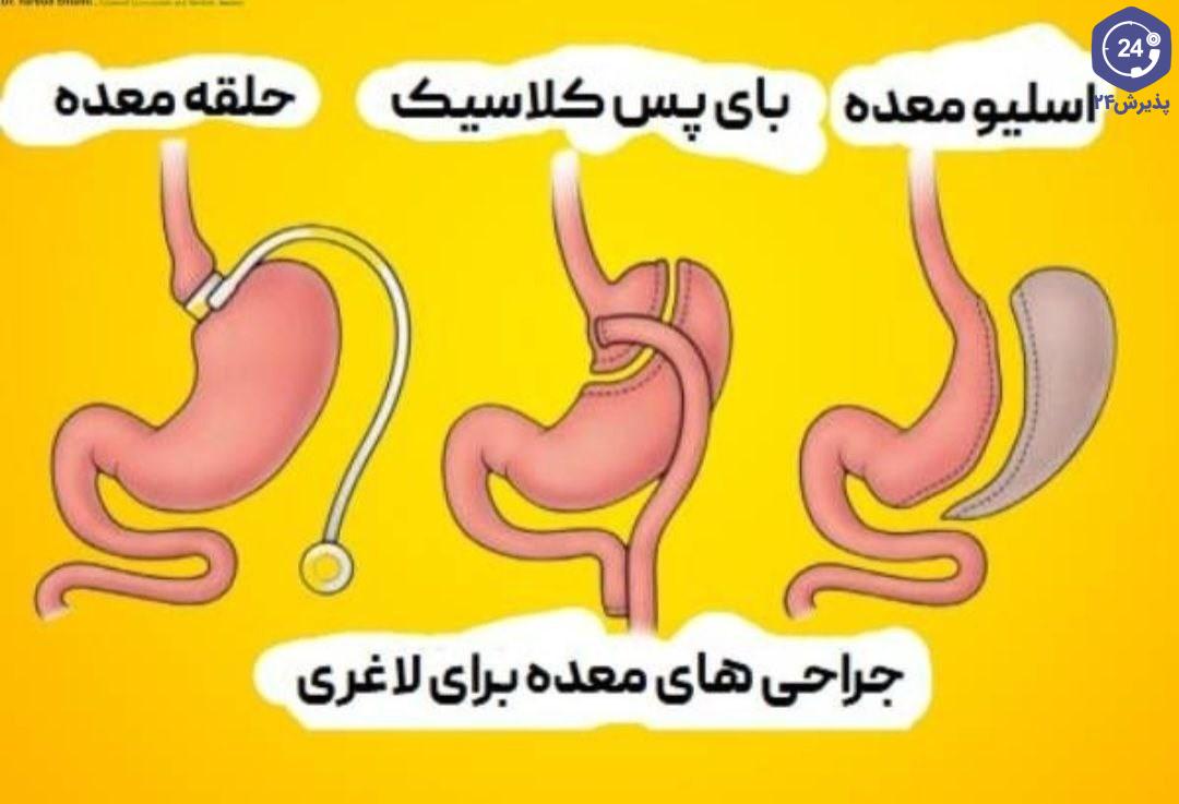 آیا لیپوماتیک خطرناک است+قبل از عمل لیپوماتیک چی بخوریم+اسلیو معده یعنی چی