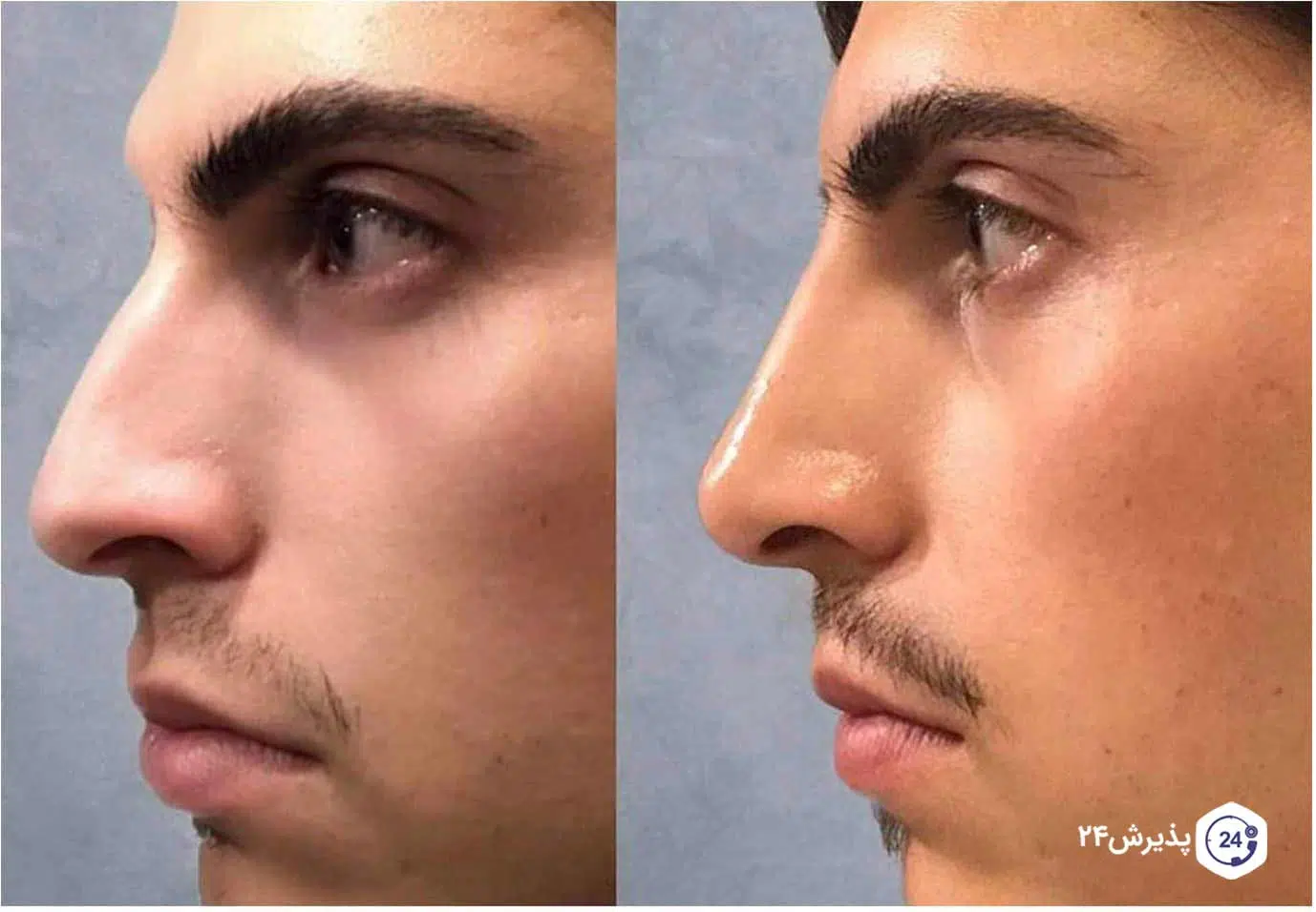 تغییرات ظاهری بینی پس از تزریق فیلر
