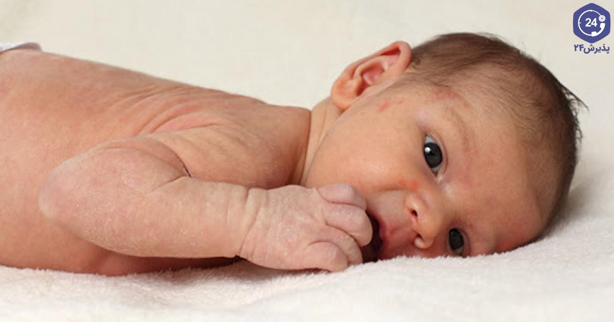 خشکی پوست نوزاد
