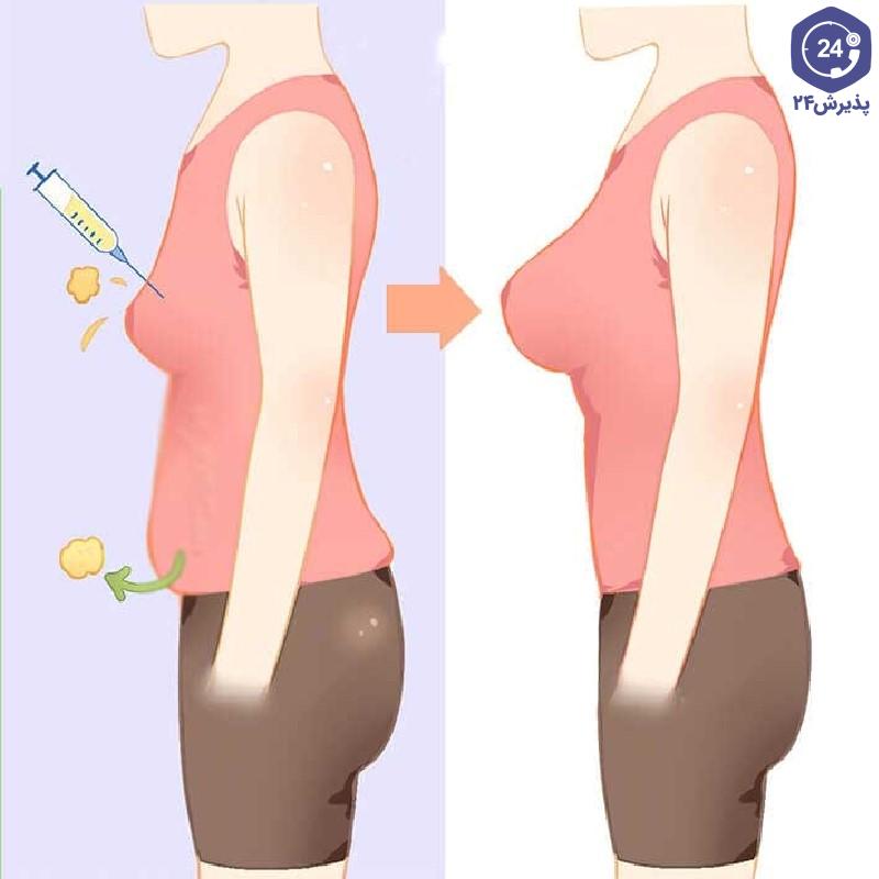 تزریق چربی به سینه