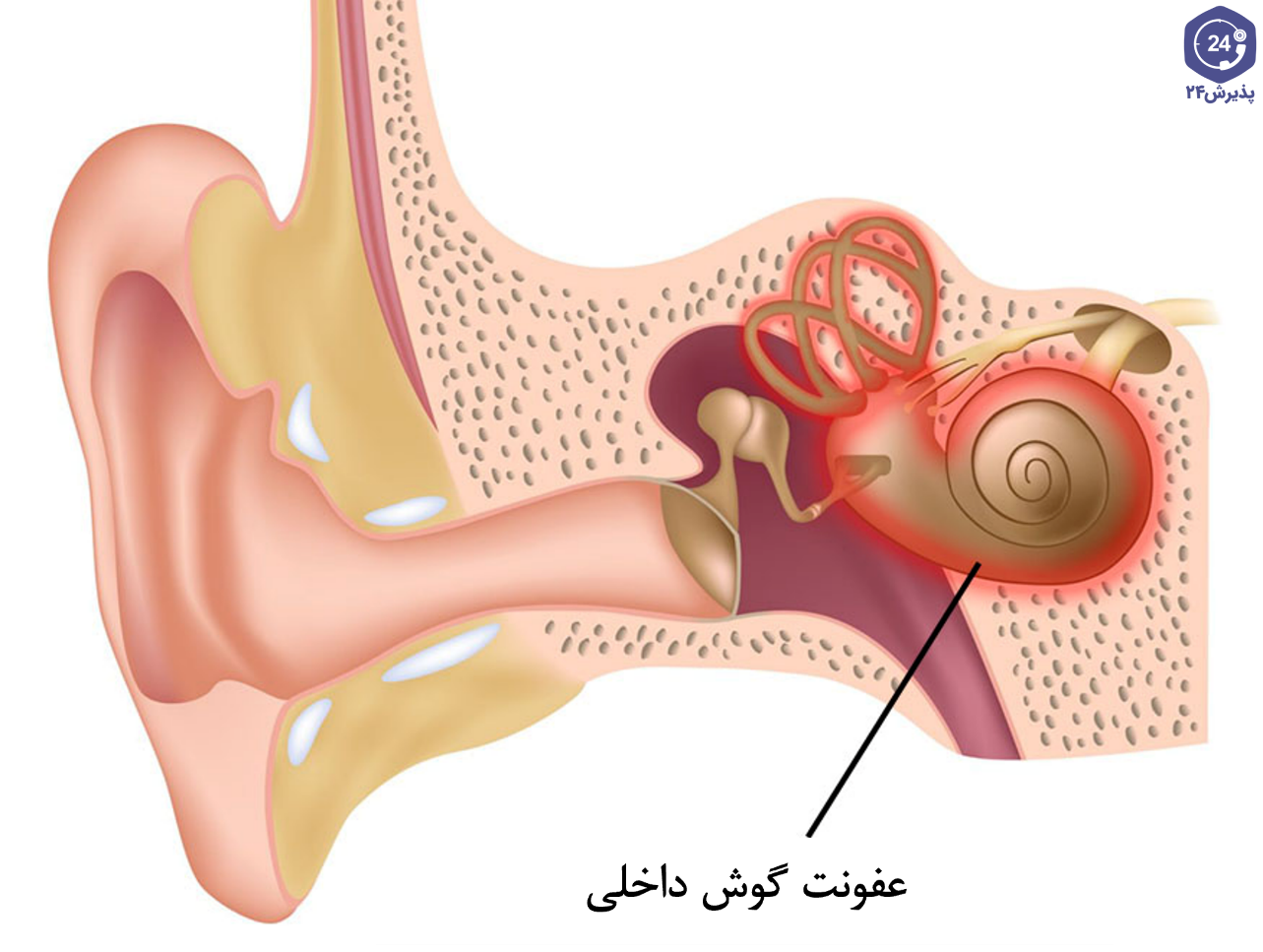 اختلال تعادل دهلیزی