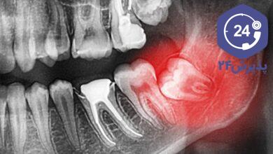 جراحی دندان عقل
