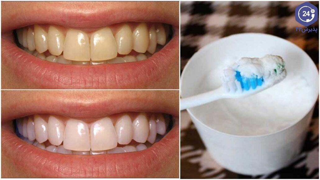 سفید کردن دندان با جوش شیرین و سرکه