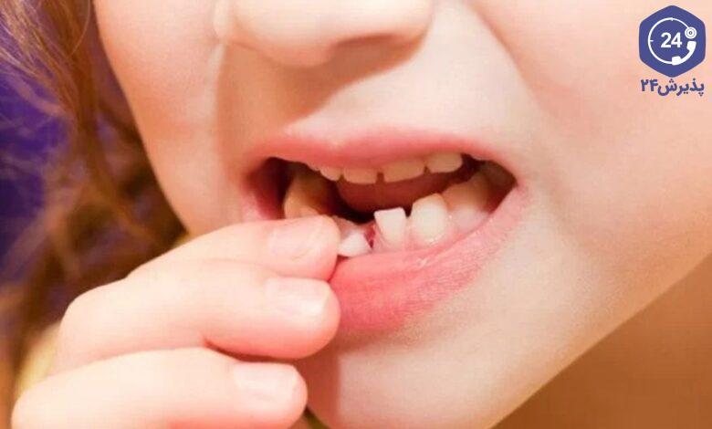 لق شدن دندان کودکان