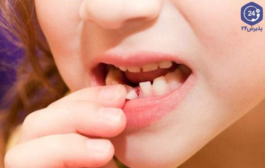 لق شدن دندان کودکان