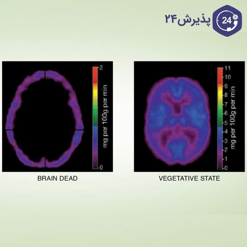 تفاوت مرگ مغزی و کما و زندگی نباتی