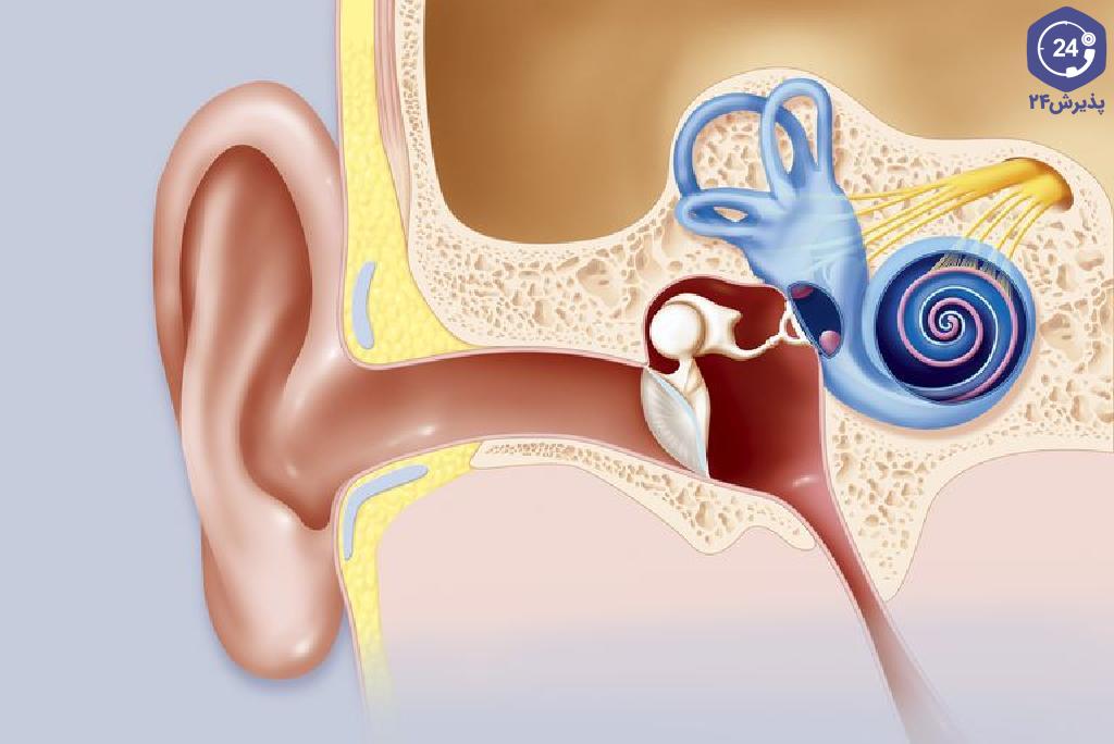 نوروم آکوستیک (تومور عصب شنوایی، acoustic neuroma)