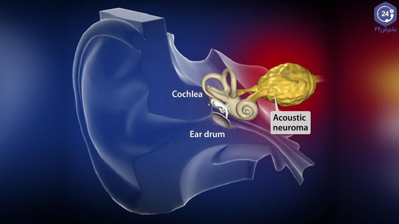 acousticneuroma_1280.jpg