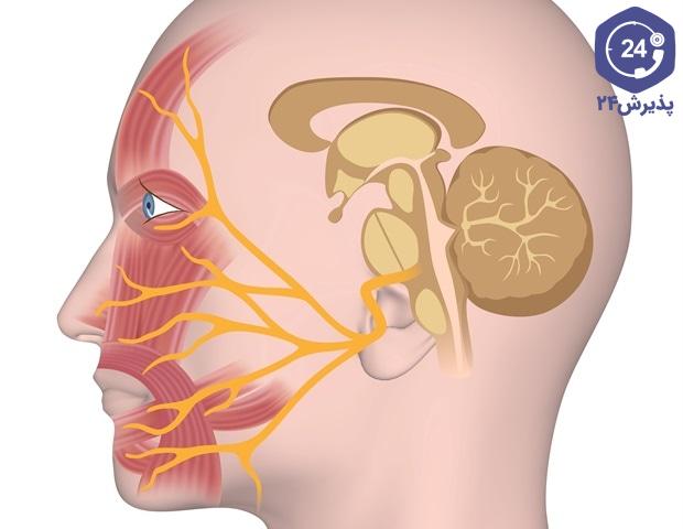 بروز اختلال فلج صورت به علت آسیب به عصب صورت