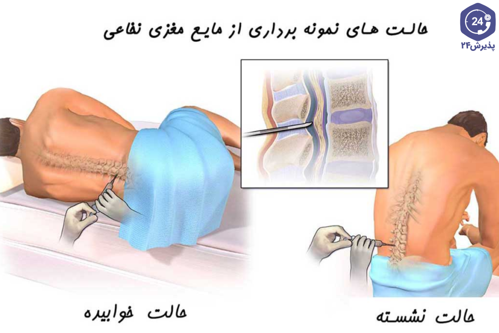 آزمایش مایع نخاعی