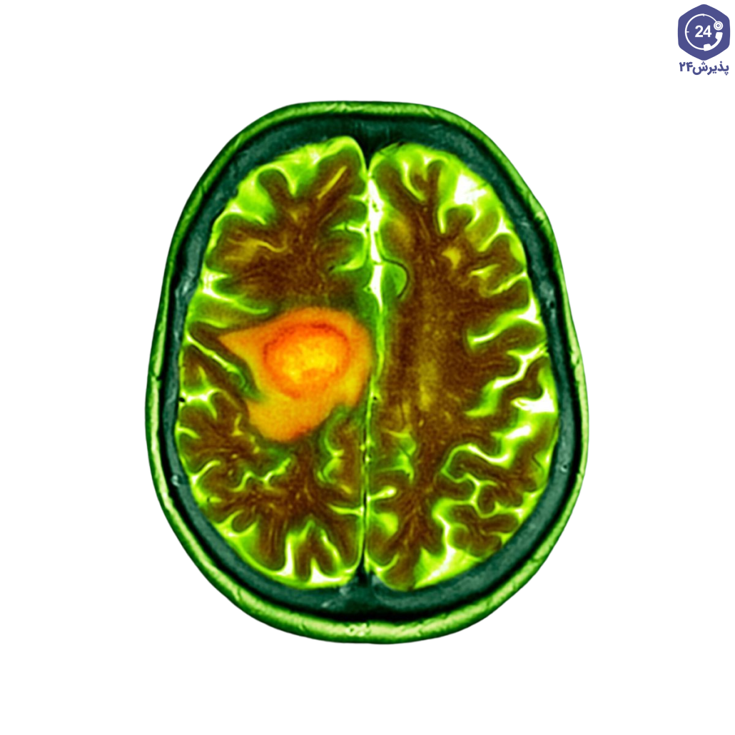 تومور مغزی گلیوبلاستوما