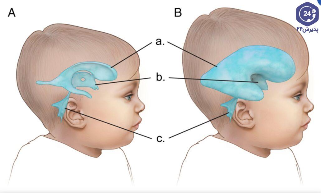 مگالنسفالی (Megalencephaly)