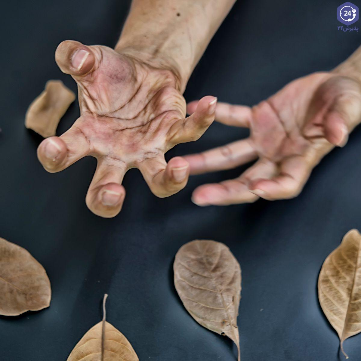 بیماری رقصاک عارضه‌ای است که بیماری‌های زیادی مثل اختلالات هورمونی، ارثی و خود ایمنی در ایجاد آن نقش دارند.