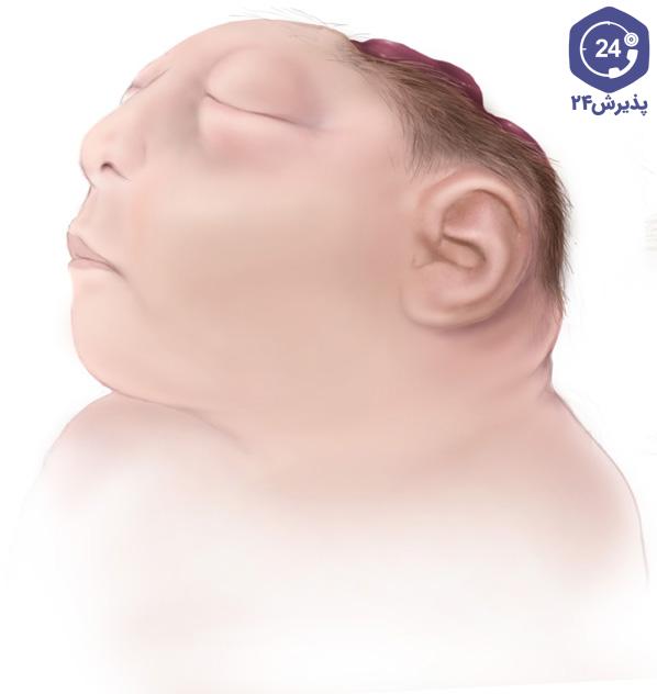 عکس نوزاد آنانسفالی