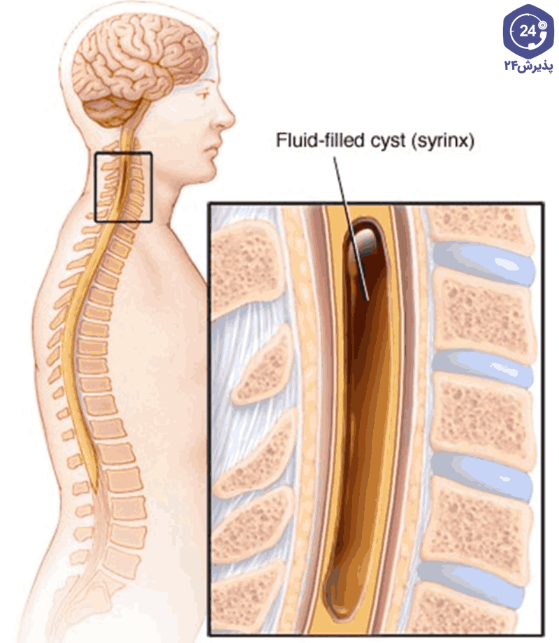 کیست پر از مایع (سیرینکس) در سیرنگومیلی