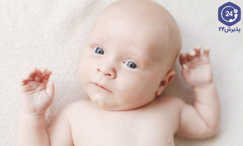 تورتیکولی در کودکان