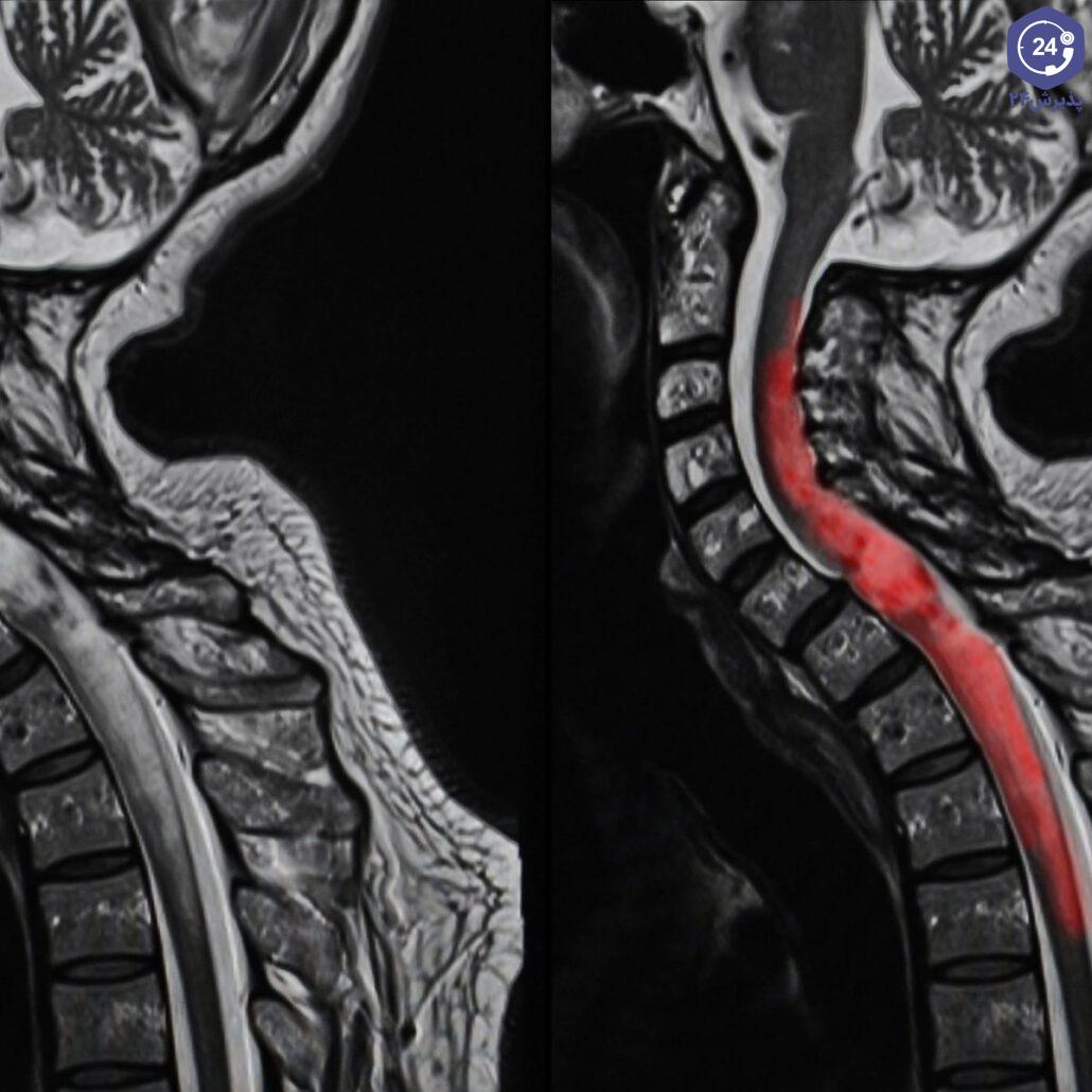 عکس تومور نخاعی