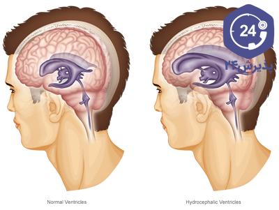 علل ابتلا به بیماری هیدروسفالی